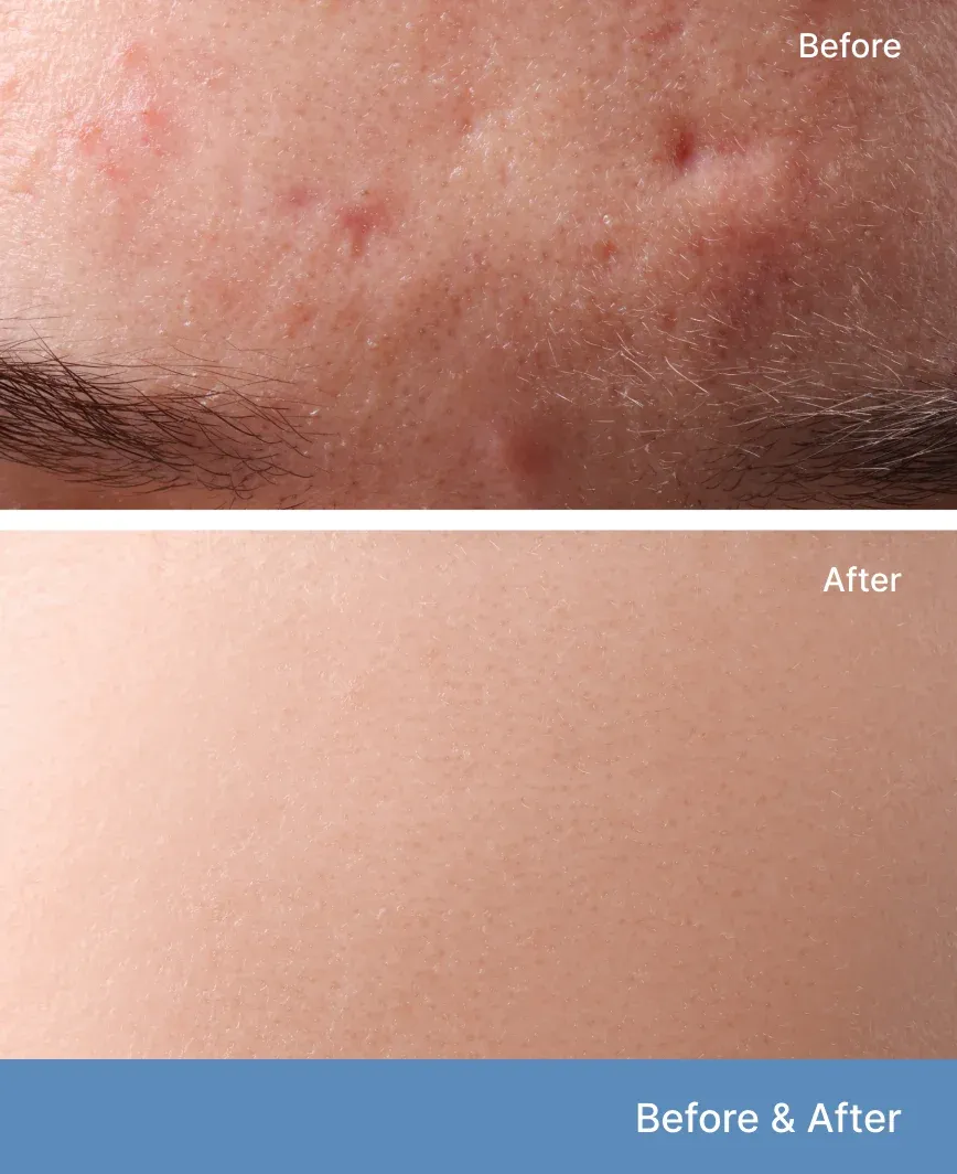 Before and after comparison of acne scar treatment on a patient's forehead showing clear skin results.