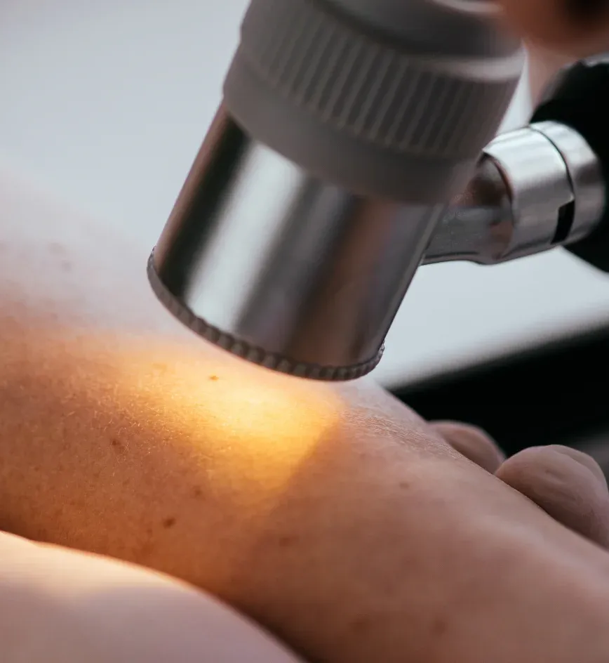 Close-up of a dermatologist using a dermatoscope to examine a mole on a patient's skin.